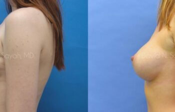 Breast Augmentation Before and After | Sayah Institute