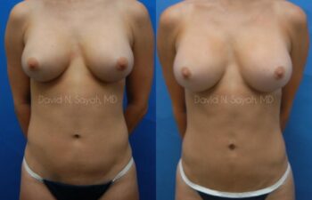 Liposuction Before and After | Sayah Institute