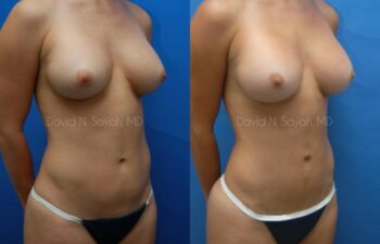 Liposuction Before and After | Sayah Institute