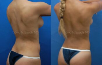 Liposuction Before and After | Sayah Institute