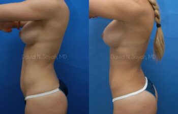 Liposuction Before and After | Sayah Institute