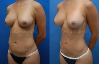 Liposuction Before and After | Sayah Institute
