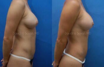 Liposuction Before and After | Sayah Institute