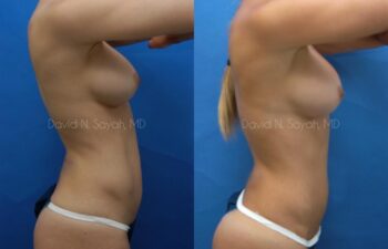 Liposuction Before and After | Sayah Institute