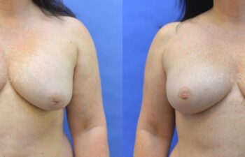Breast Implant Removal Before and After | Sayah Institute