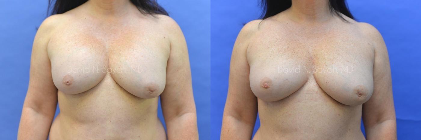 Breast Implant Removal Before and After | Sayah Institute