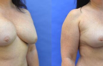 Breast Implant Removal Before and After | Sayah Institute