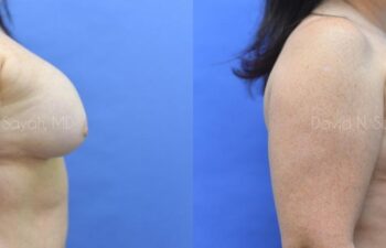 Breast Implant Removal Before and After | Sayah Institute
