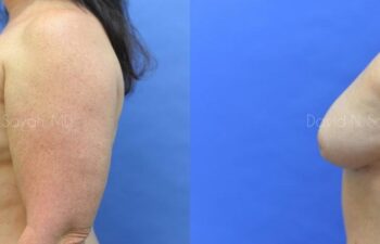 Breast Implant Removal Before and After | Sayah Institute
