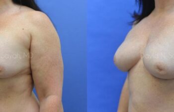 Breast Implant Removal Before and After | Sayah Institute