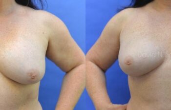 Breast Implant Removal Before and After | Sayah Institute