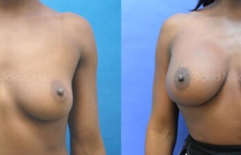 Breast Augmentation Before and After | Sayah Institute