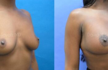 Breast Augmentation Before and After | Sayah Institute