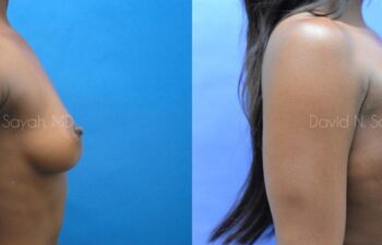 Breast Augmentation Before and After | Sayah Institute