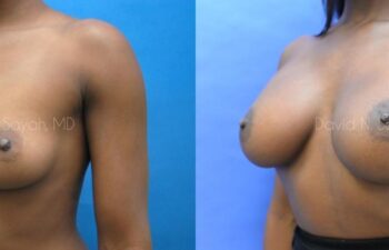 Breast Augmentation Before and After | Sayah Institute