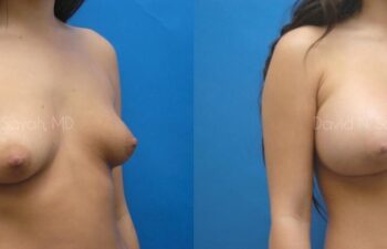 Breast Augmentation Before and After | Sayah Institute