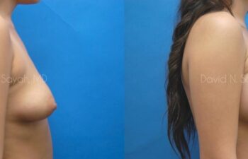 Breast Augmentation Before and After | Sayah Institute