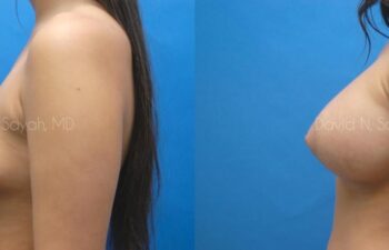 Breast Augmentation Before and After | Sayah Institute