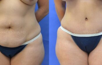 Liposuction Before and After | Sayah Institute
