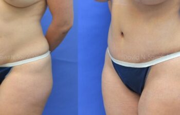 Liposuction Before and After | Sayah Institute