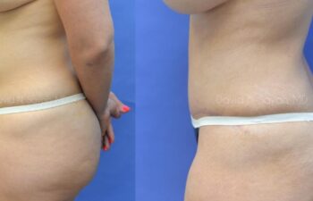 Liposuction Before and After | Sayah Institute