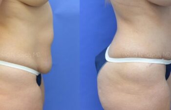Liposuction Before and After | Sayah Institute