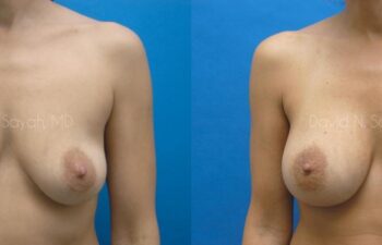 Breast Augmentation Before and After | Sayah Institute