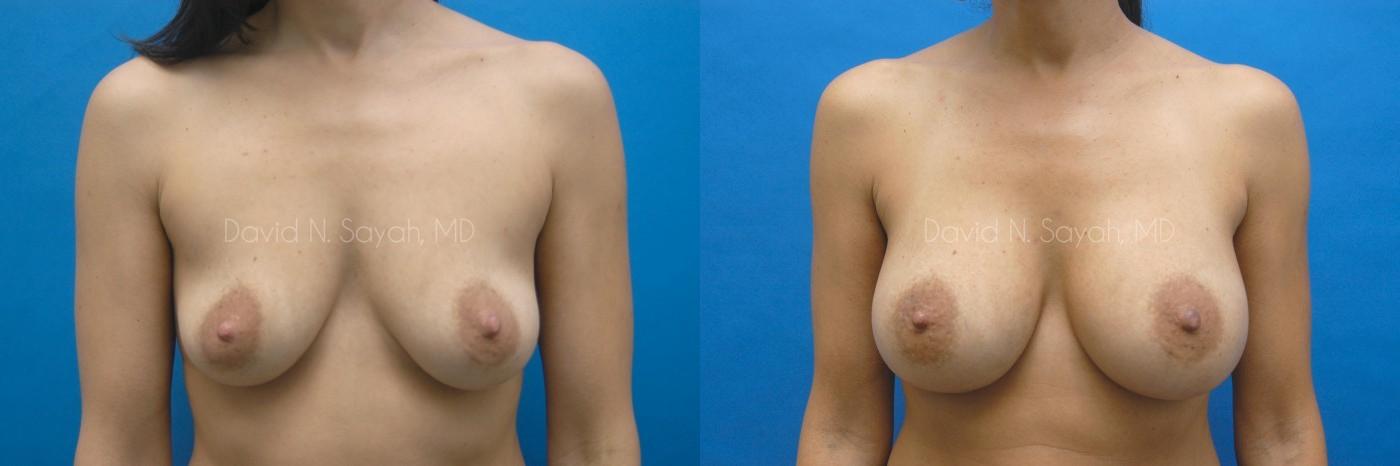 Breast Augmentation Before and After | Sayah Institute