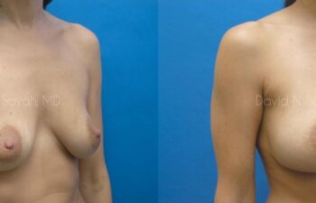 Breast Augmentation Before and After | Sayah Institute