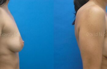 Breast Augmentation Before and After | Sayah Institute