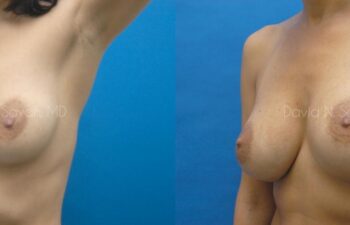 Breast Augmentation Before and After | Sayah Institute