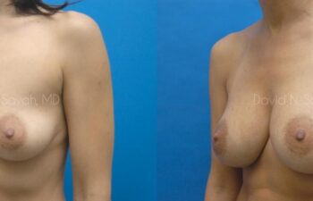Breast Augmentation Before and After | Sayah Institute