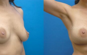 Breast Augmentation Before and After | Sayah Institute