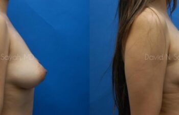 Fat Injection Breast Before and After | Sayah Institute