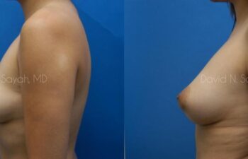 Fat Injection Breast Before and After | Sayah Institute