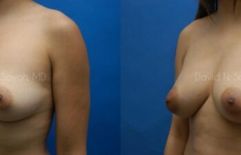 Fat Injection Breast Before and After | Sayah Institute