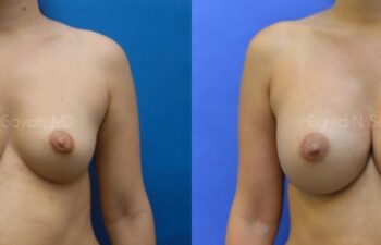 Breast Augmentation Before and After | Sayah Institute