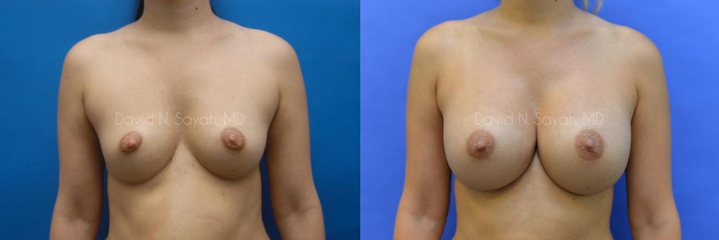 Breast Augmentation Before and After | Sayah Institute