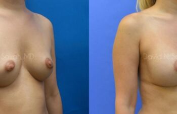 Breast Augmentation Before and After | Sayah Institute