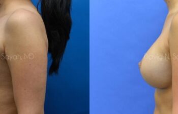Breast Augmentation Before and After | Sayah Institute