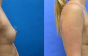 Breast Augmentation Before and After | Sayah Institute