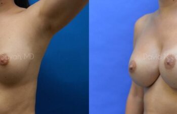 Breast Augmentation Before and After | Sayah Institute