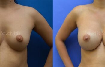 Breast Augmentation Before and After | Sayah Institute