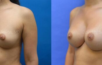 Breast Augmentation Before and After | Sayah Institute