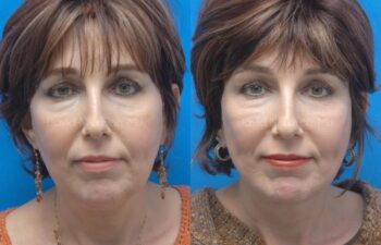 Facelift Before and After | Sayah Institute