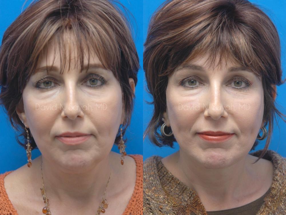 Facelift Before and After | Sayah Institute