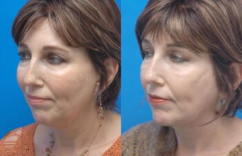 Facelift Before and After | Sayah Institute