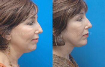 Facelift Before and After | Sayah Institute