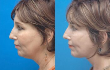 Facelift Before and After | Sayah Institute