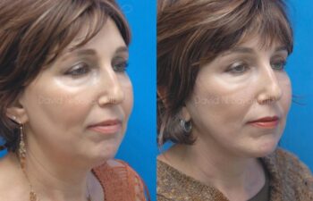 Facelift Before and After | Sayah Institute